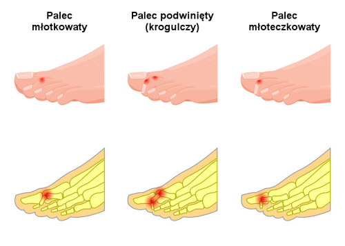 Palce PL-2.png
