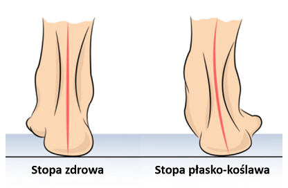 stopa płasko -koślawa.PNG