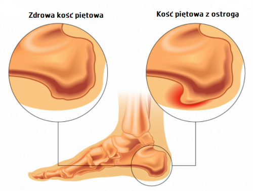 Ostroga piętowa-04-2.png