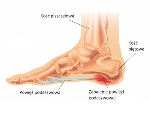 Zapalenie powięzi grafika.PNG