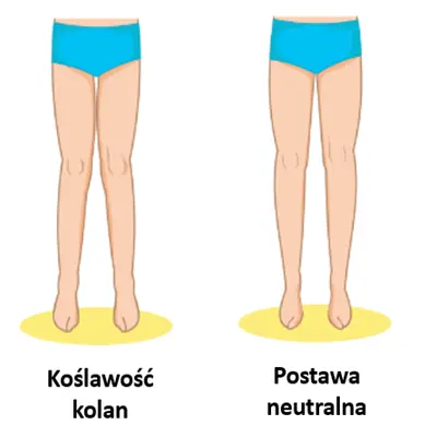 Koślawość kolan